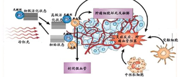 一文看懂“光动力疗法（PDT）”是如何利用光线杀死癌细胞的？