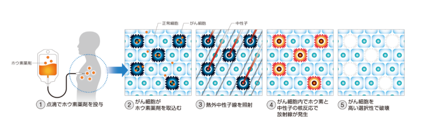 深入了解！！“硼中子俘获疗法（BNCT）”的原理和常见问题，探索癌症治疗的新方向！